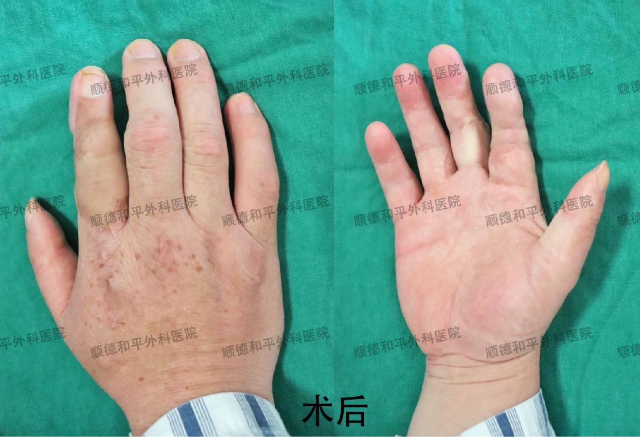 新疆患者失去手指心生自卑，遠赴廣東手指再造＿手外科醫院咨詢(圖2)